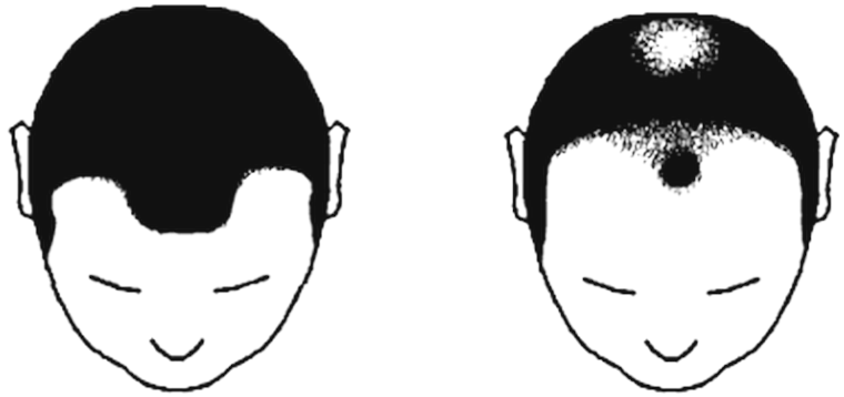 The same head at Norwood 2 and at Norwood 5, 13 years apart